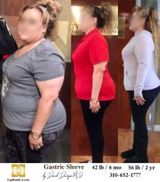 Bariatric Surgery - Before & After Weight Loss Surgery Photo - Gastric Band Sleeve Bypass Balloon