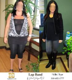 Bariatric Surgery - Before & After Weight Loss Surgery Photo - Gastric Band Sleeve Bypass Balloon