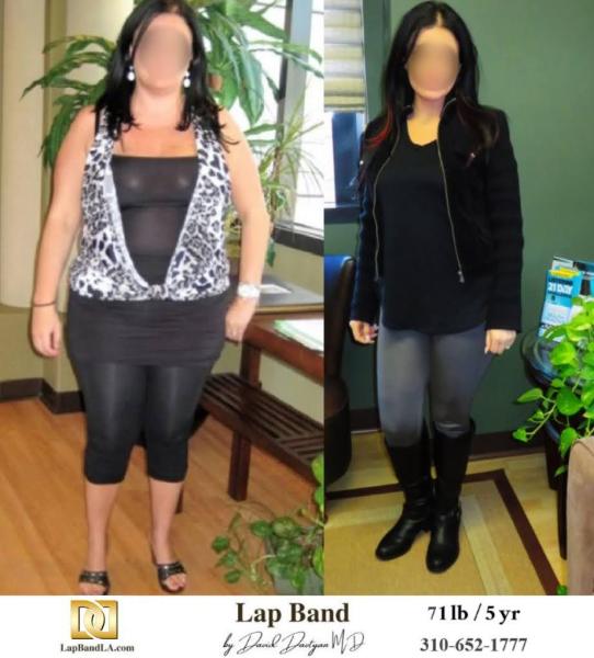 Bariatric Surgery - Before & After Weight Loss Surgery Photo - Gastric Band Sleeve Bypass Balloon