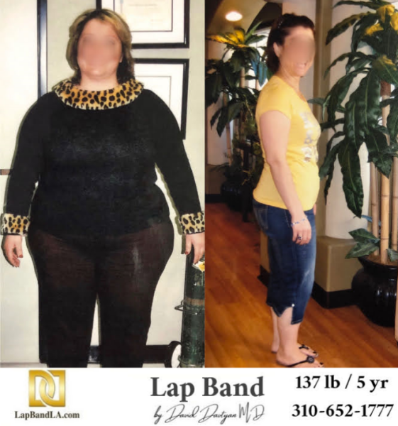 Bariatric Surgery - Before & After Weight Loss Surgery Photo - Gastric Band Sleeve Bypass Balloon