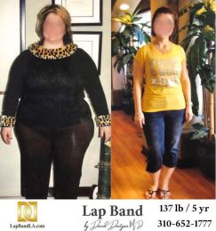Bariatric Surgery - Before & After Weight Loss Surgery Photo - Gastric Band Sleeve Bypass Balloon