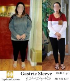 Bariatric Surgery - Before & After Weight Loss Surgery Photo - Gastric Band Sleeve Bypass Balloon