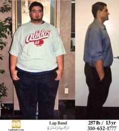 Bariatric Surgery - Before & After Weight Loss Surgery Photo - Gastric Band Sleeve Bypass Balloon