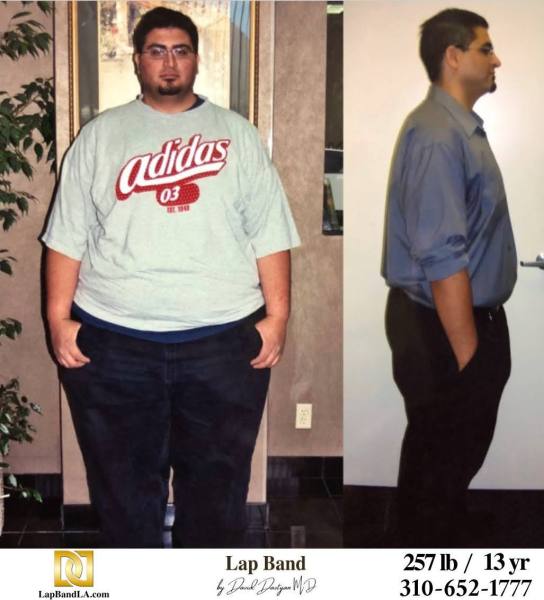 Bariatric Surgery - Before & After Weight Loss Surgery Photo - Gastric Band Sleeve Bypass Balloon