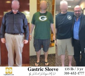 Bariatric Surgery - Before & After Weight Loss Surgery Photo - Gastric Band Sleeve Bypass Balloon