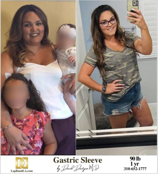 Bariatric Surgery - Before & After Weight Loss Surgery Photo - Gastric Band Sleeve Bypass Balloon