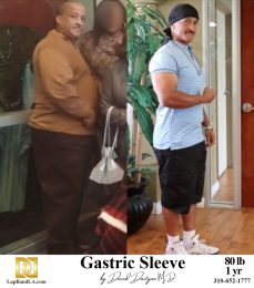 Bariatric Surgery - Before & After Weight Loss Surgery Photo - Gastric Band Sleeve Bypass Balloon