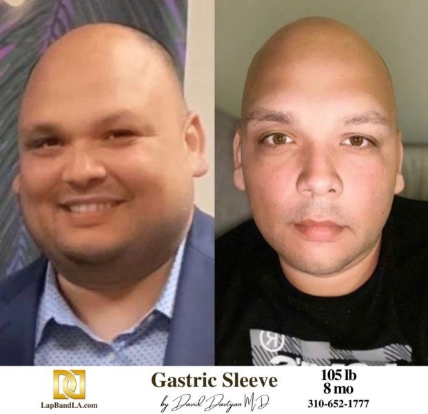 Bariatric Surgery - Before & After Weight Loss Surgery Photo - Gastric Band Sleeve Bypass Balloon
