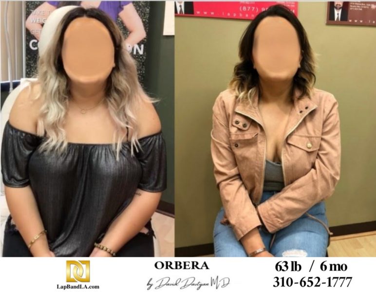 Bariatric Surgery - Before & After Weight Loss Surgery Photo - Gastric Band Sleeve Bypass Balloon