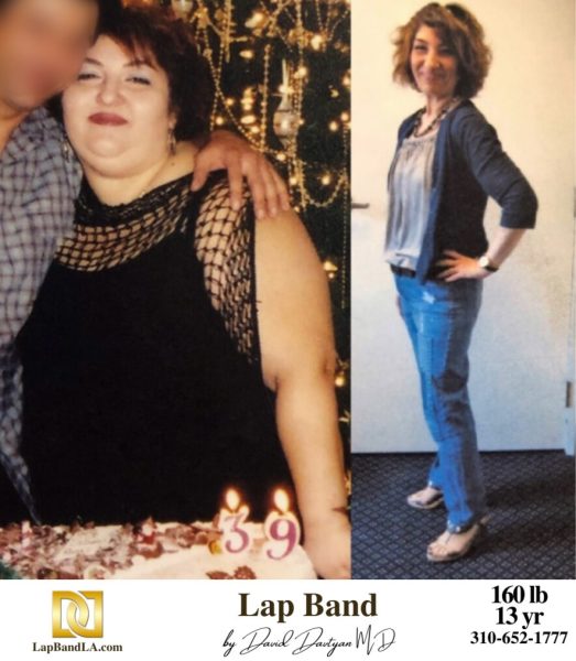 Bariatric Surgery - Before & After Weight Loss Surgery Photo - Gastric Band Sleeve Bypass Balloon