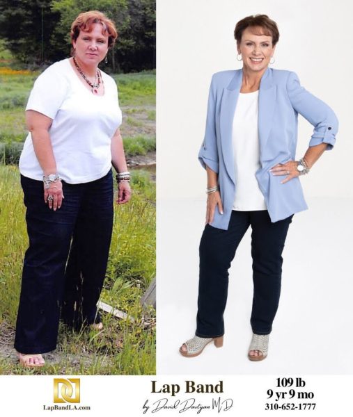 Bariatric Surgery - Before & After Weight Loss Surgery Photo - Gastric Band Sleeve Bypass Balloon