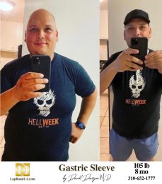 Bariatric Surgery - Before & After Weight Loss Surgery Photo - Gastric Band Sleeve Bypass Balloon