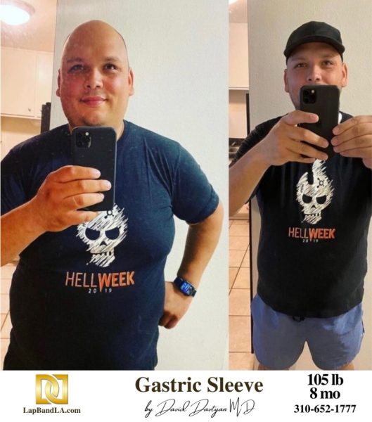 Bariatric Surgery - Before & After Weight Loss Surgery Photo - Gastric Band Sleeve Bypass Balloon