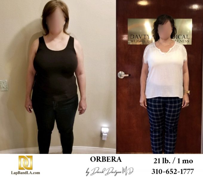 Bariatric Surgery - Before & After Weight Loss Surgery Photo - Gastric Band Sleeve Bypass Balloon