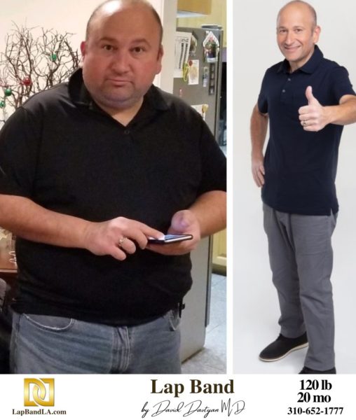 Bariatric Surgery - Before & After Weight Loss Surgery Photo - Gastric Band Sleeve Bypass Balloon