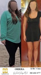Bariatric Surgery - Before & After Weight Loss Surgery Photo - Gastric Band Sleeve Bypass Balloon