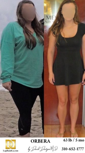 Bariatric Surgery - Before & After Weight Loss Surgery Photo - Gastric Band Sleeve Bypass Balloon