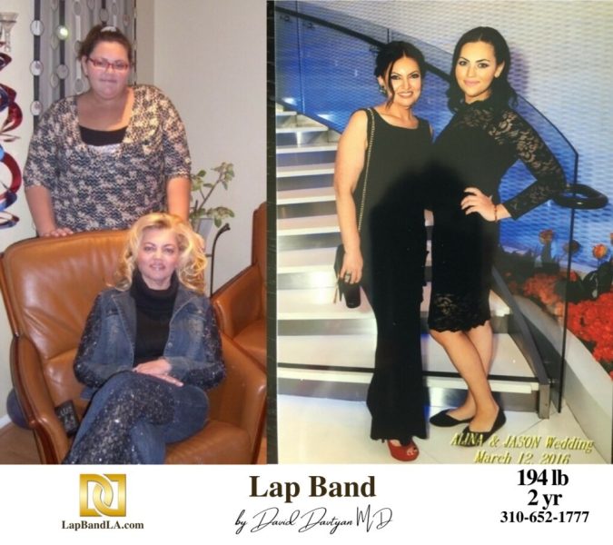 Bariatric Surgery - Before & After Weight Loss Surgery Photo - Gastric Band Sleeve Bypass Balloon