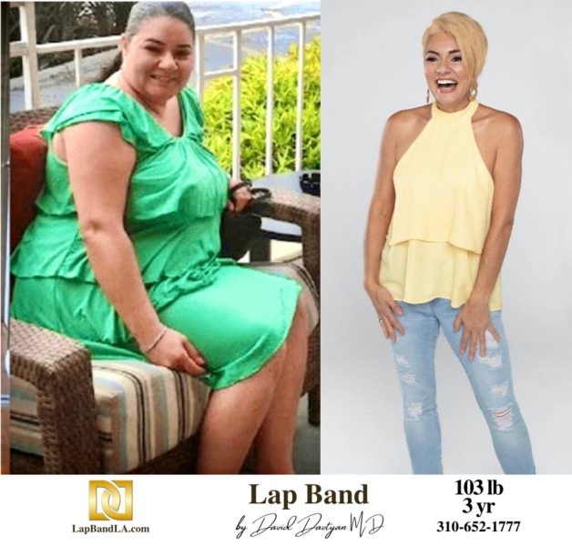 Bariatric Surgery - Before & After Weight Loss Surgery Photo - Gastric Band Sleeve Bypass Balloon