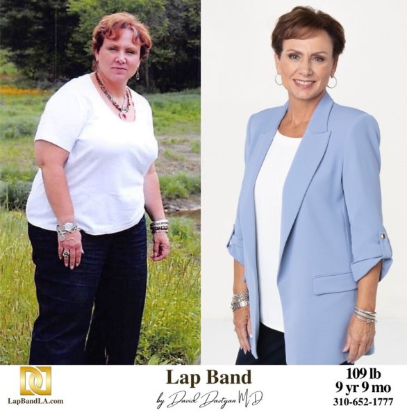 Bariatric Surgery - Before & After Weight Loss Surgery Photo - Gastric Band Sleeve Bypass Balloon