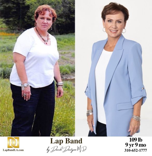 Bariatric Surgery - Before & After Weight Loss Surgery Photo - Gastric Band Sleeve Bypass Balloon