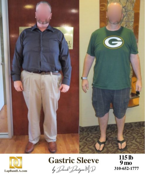 Bariatric Surgery - Before & After Weight Loss Surgery Photo - Gastric Band Sleeve Bypass Balloon
