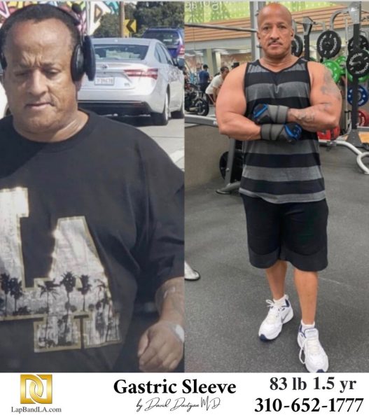 Bariatric Surgery - Before & After Weight Loss Surgery Photo - Gastric Band Sleeve Bypass Balloon