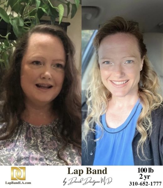 Bariatric Surgery - Before & After Weight Loss Surgery Photo - Gastric Band Sleeve Bypass Balloon