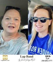 Bariatric Surgery - Before & After Weight Loss Surgery Photo - Gastric Band Sleeve Bypass Balloon