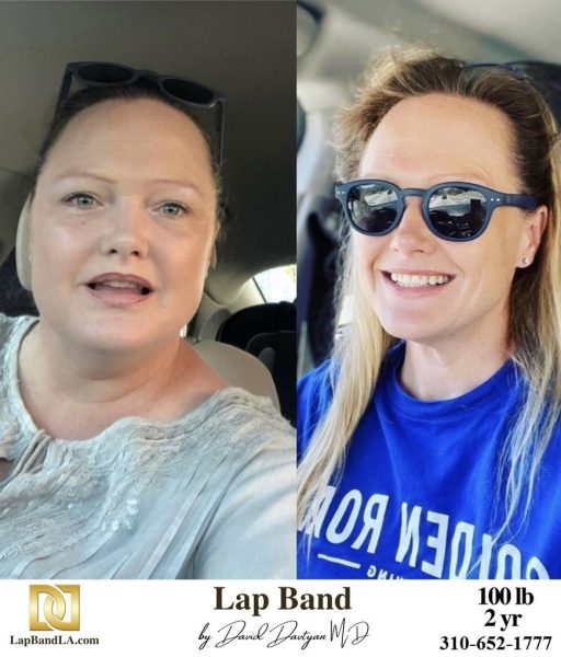 Bariatric Surgery - Before & After Weight Loss Surgery Photo - Gastric Band Sleeve Bypass Balloon