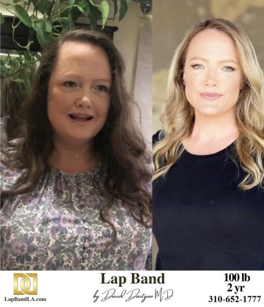 Bariatric Surgery - Before & After Weight Loss Surgery Photo - Gastric Band Sleeve Bypass Balloon