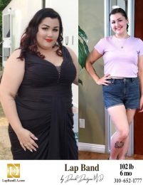 Bariatric Surgery - Before & After Weight Loss Surgery Photo - Gastric Band Sleeve Bypass Balloon