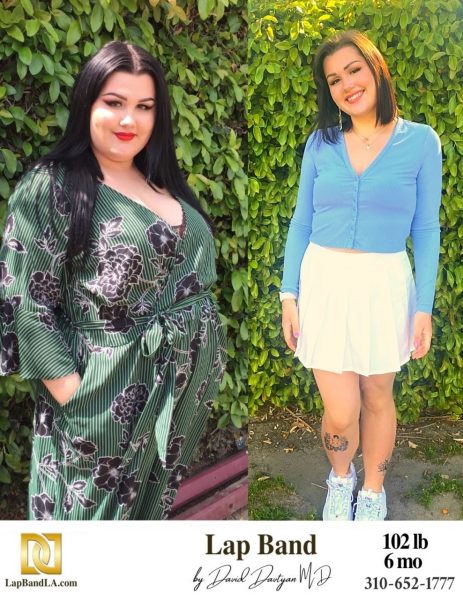 Bariatric Surgery - Before & After Weight Loss Surgery Photo - Gastric Band Sleeve Bypass Balloon