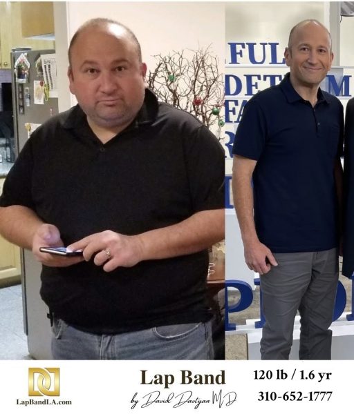 Bariatric Surgery - Before & After Weight Loss Surgery Photo - Gastric Band Sleeve Bypass Balloon