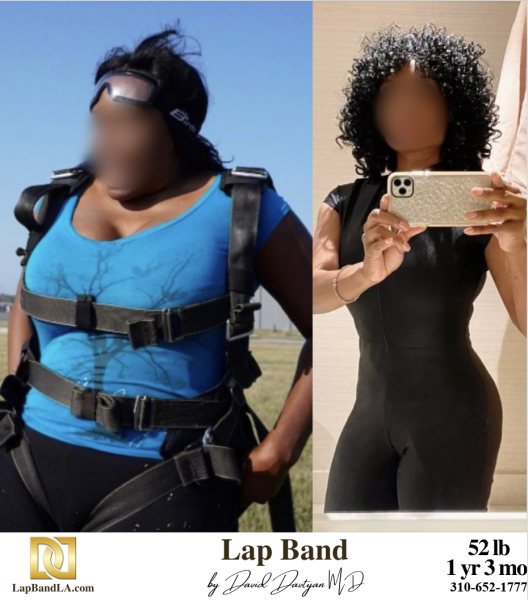 Bariatric Surgery - Before & After Weight Loss Surgery Photo - Gastric Band Sleeve Bypass Balloon