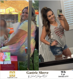 Bariatric Surgery - Before & After Weight Loss Surgery Photo - Gastric Band Sleeve Bypass Balloon
