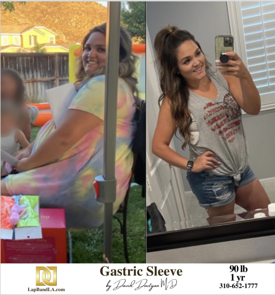 Bariatric Surgery - Before & After Weight Loss Surgery Photo - Gastric Band Sleeve Bypass Balloon