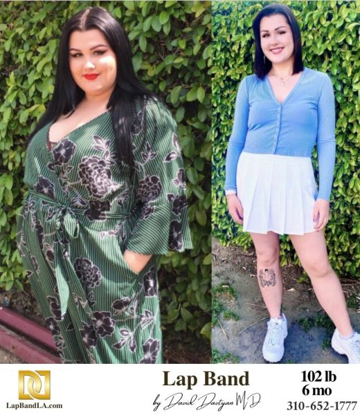 Bariatric Surgery - Before & After Weight Loss Surgery Photo - Gastric Band Sleeve Bypass Balloon