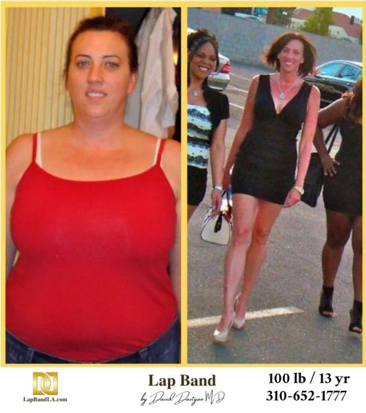 Bariatric Surgery - Before & After Weight Loss Surgery Photo - Gastric Band Sleeve Bypass Balloon