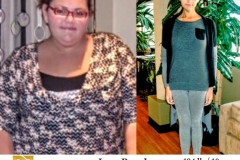 Bariatric Surgery - Before & After Weight Loss Surgery Photo - Gastric Band Sleeve Bypass Balloon