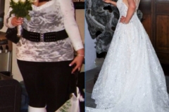 Bariatric Surgery - Before & After Weight Loss Surgery Photo - Gastric Band Sleeve Bypass Balloon