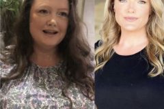 Bariatric Surgery - Before & After Weight Loss Surgery Photo - Gastric Band Sleeve Bypass Balloon