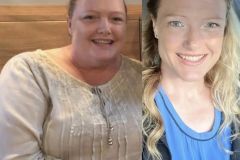 Bariatric Surgery - Before & After Weight Loss Surgery Photo - Gastric Band Sleeve Bypass Balloon