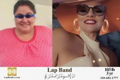 Bariatric Surgery - Before & After Weight Loss Surgery Photo - Gastric Band Sleeve Bypass Balloon