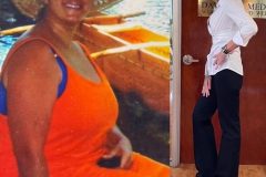 Bariatric Surgery - Before & After Weight Loss Surgery Photo - Gastric Band Sleeve Bypass Balloon