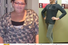 Bariatric Surgery - Before & After Weight Loss Surgery Photo - Gastric Band Sleeve Bypass Balloon