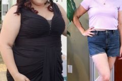 Bariatric Surgery - Before & After Weight Loss Surgery Photo - Gastric Band Sleeve Bypass Balloon
