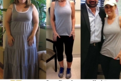 Bariatric Surgery - Before & After Weight Loss Surgery Photo - Gastric Band Sleeve Bypass Balloon