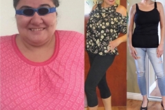 Bariatric Surgery - Before & After Weight Loss Surgery Photo - Gastric Band Sleeve Bypass Balloon