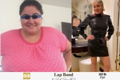 Bariatric Surgery - Before & After Weight Loss Surgery Photo - Gastric Band Sleeve Bypass Balloon